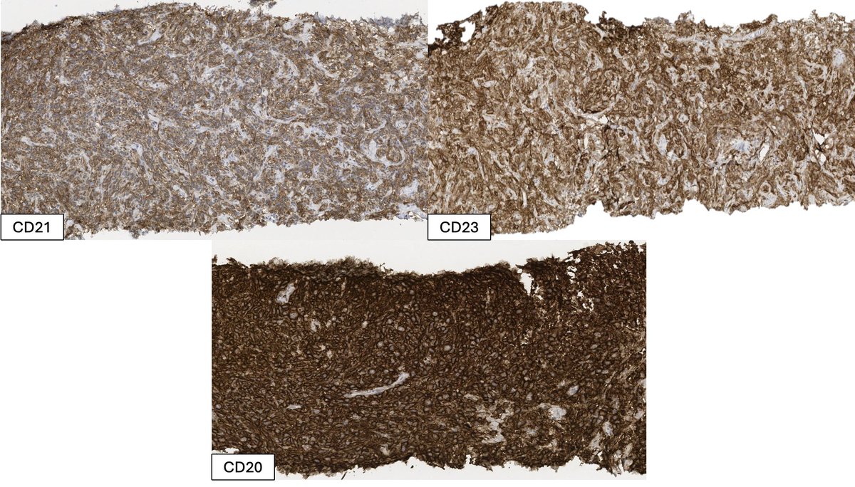 Relapsed DLBCL with unusual spindle-cell morphology, reminiscent of follicular dendritic cell sarcoma (FDCS), with diffuse aberrant expression of FDC markers CD21 and CD23 #hemepath #lymsm #surgpath #pathtwitter #pathX #MedTwitter #MedX #MedEd