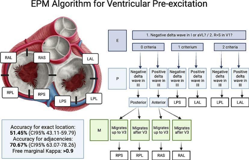 EPM algorithm: A stepwise approach to accessory pathway localization in ventricular pre-excitation #JECG #NewOnline doi.org/10.1016/j.jele…