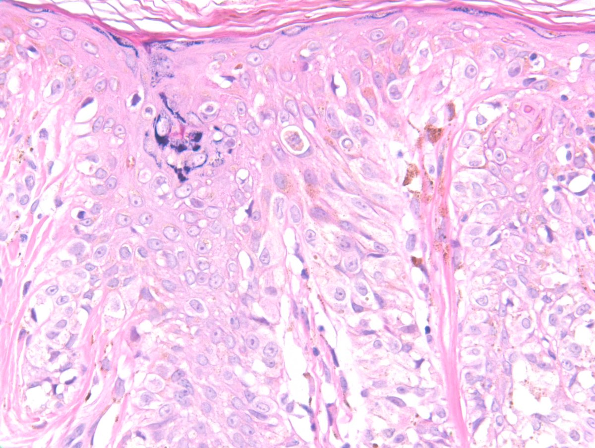 Richard Carr (@racarr51) on Twitter photo 2024 Wk13 Thurs: M~70. Longstanding mole lower back, has changed, clinically slightly variegated colour. 4 opinions & sharing #dermpath <a href="/david_terrano/">David Terrano</a> 2024 Wk13 Thurs: M~70. Longstanding mole lower back, has changed, clinically slightly variegated colour. 4 opinions & sharing #dermpath <a href="/david_terrano/">David Terrano</a>