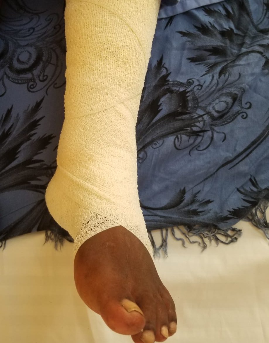 Jamal Hassan (@jfinspires_) on Twitter photo Alhamdulillah surgery was successful and her leg is now straightened. Wishing her quick recovery. Thanks to all those involved. Alhamdulillah surgery was successful and her leg is now straightened. Wishing her quick recovery. Thanks to all those involved.