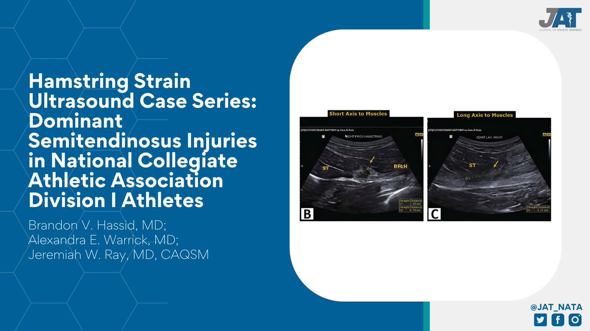 In the new issue, Brandon V. Hassid, MD and colleagues examined ultrasound images of 38 athletes with acute hamstring strains for injury location and affected muscles. Article: tinyurl.com/4tjd2246