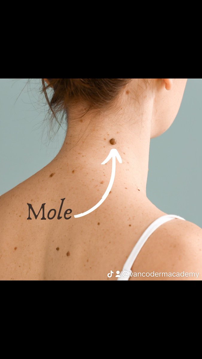 Based on #Moles location on the skin, moles can be classified into three main #types: #vancodermacademy
