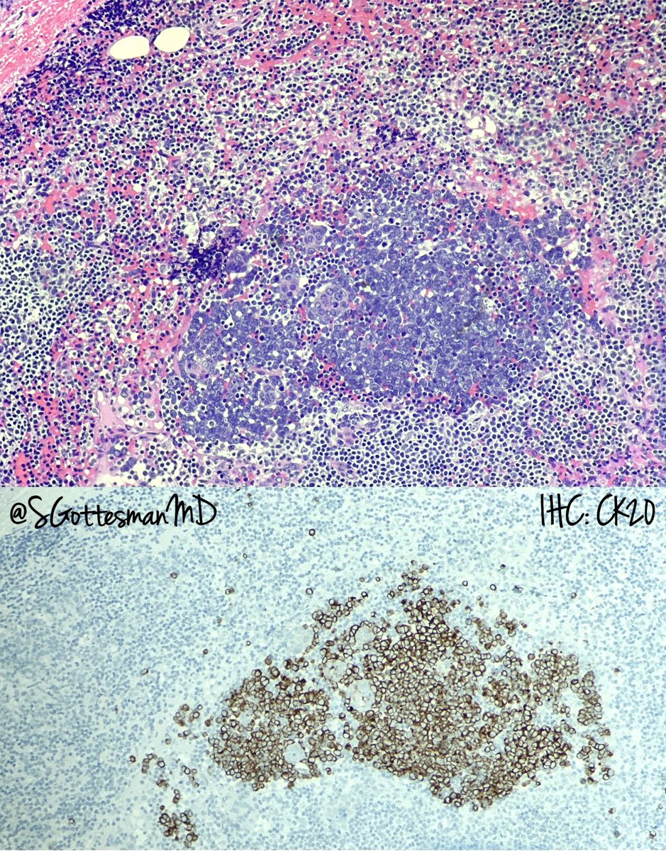 Merkel cell carcinoma: small metastasis in a lymph node. Very nice cellular contrast on H&E alone. Salt-and-pepper chromatin. #RealLifeDermpath #dermtwitter #dermpath