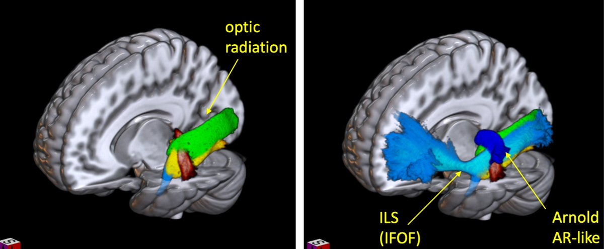 Maldonado et al. use in vivo tractography and post-mortem dissections to study the connections joining the pulvinar to the temporal lobe. They describe four branches, and study their functions via electrical stimulation in awake surgery. tinyurl.com/42vkzvjw