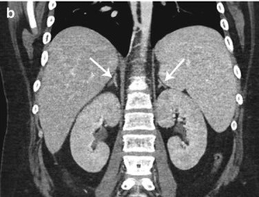 Adrenal masses are commonly found on scans performed for other reasons. More than 75% are benign (not cancer) and don't produce too much of their normal hormones. Masses ≥ 1 cm in size require further testing. #AADAM2024 @NADF_Adrenal @TheAACE @TheEndoSociety