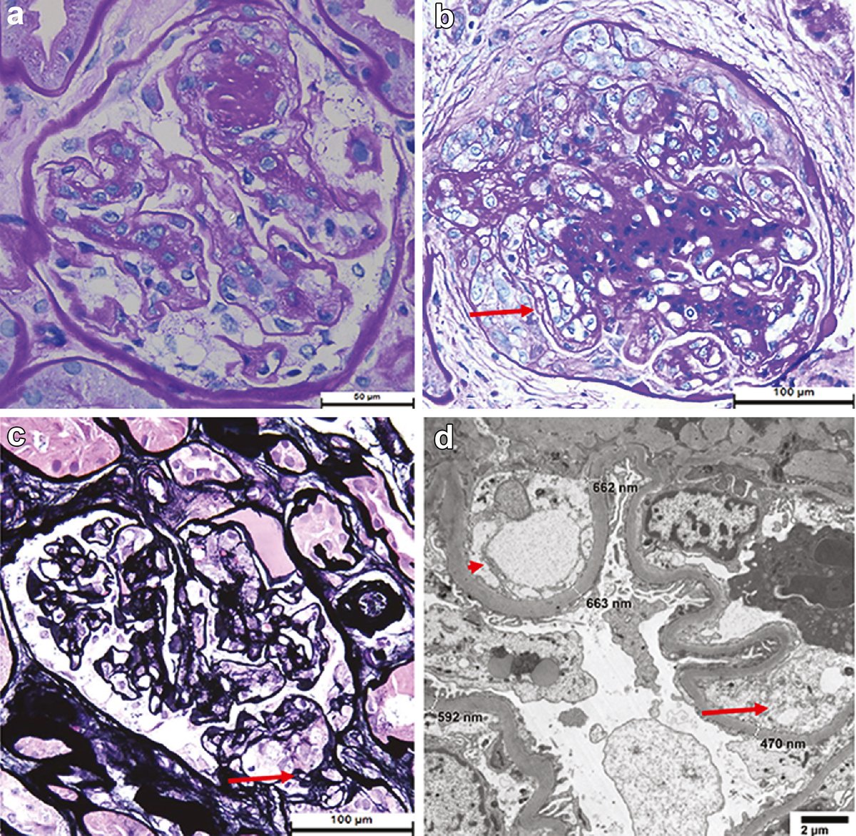 A case-based narrative review of #pregnancy-associated #atypicalhemolyticuremicsyndrome/#complement-mediated thrombotic microangiopathy

doi.org/10.1016/j.kint…

@uOttawaMed @IntMedatIowa @QueensuDOM @UofT_LMP @uoftmedicine 
#KIReview #OpenAccess #aHUS #renalpath #nephropath