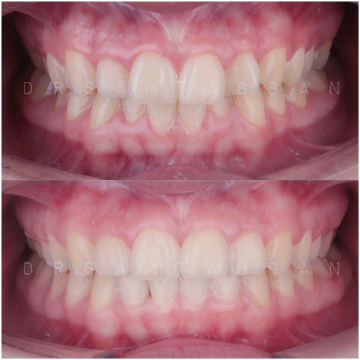 Before & After of crowded lower & upper arches
.
قبل وبعد لحالة تزاحم فك سفلي وعلوي
.
#drsamtabban #iworkusmile #ortodentolatino #invisalign #orthodontics #تقويم_شفاف #انفيزالاين