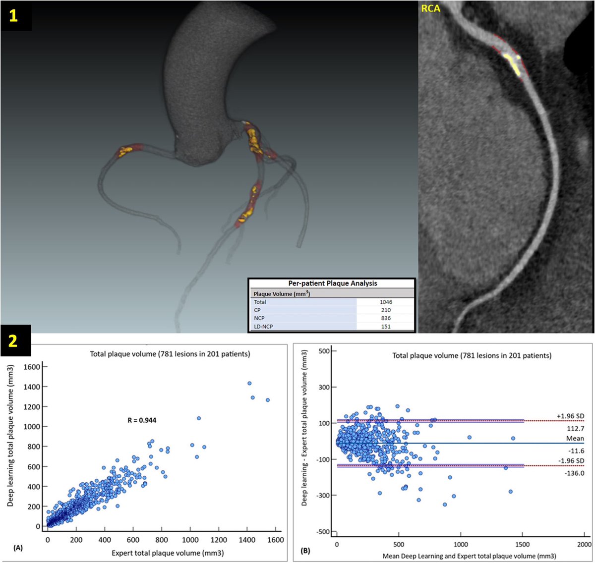 Validation of a fully automated deep learning-enabled solution for CCTA atherosclerotic plaque and stenosis quantification in a diverse real-world cohort @journalCCT @Heart_SCCT authors.elsevier.com/a/1iqmw6tu1iBP… @danilorenzatti @analyzeF @pamelapina_s @AndreaScotti21 @aschenonegiugni