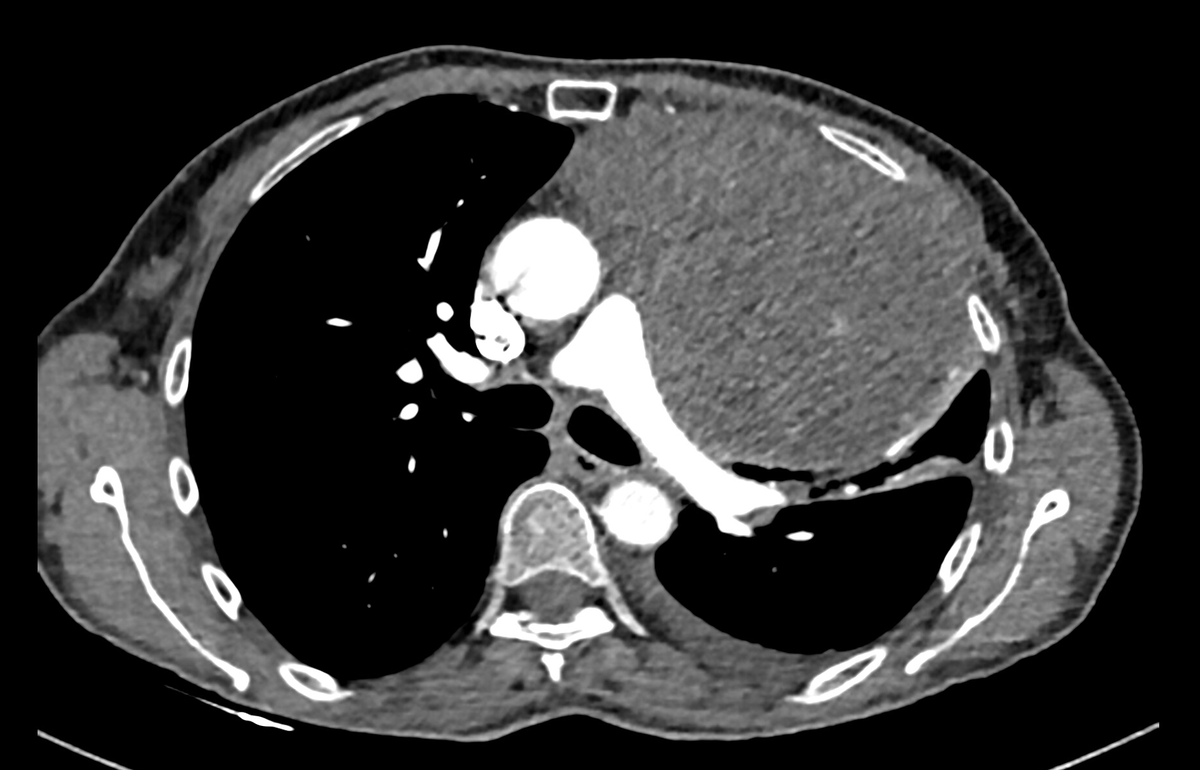 surgery25975's tweet image. Yesterday we used for the first time Intercostal Cryoanalgesia. Challenging  case of giant Thymoma resected through a left hemi-clamshell thoracotomy.24h after surgery patient is with an EVA of 4/10.Promising pain control results considering surgical aggression.Thanks @EvoMedical