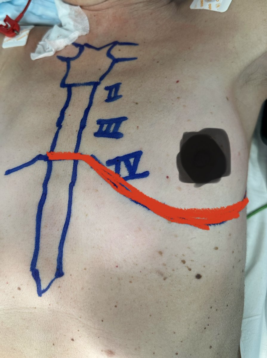 surgery25975's tweet image. Yesterday we used for the first time Intercostal Cryoanalgesia. Challenging  case of giant Thymoma resected through a left hemi-clamshell thoracotomy.24h after surgery patient is with an EVA of 4/10.Promising pain control results considering surgical aggression.Thanks @EvoMedical