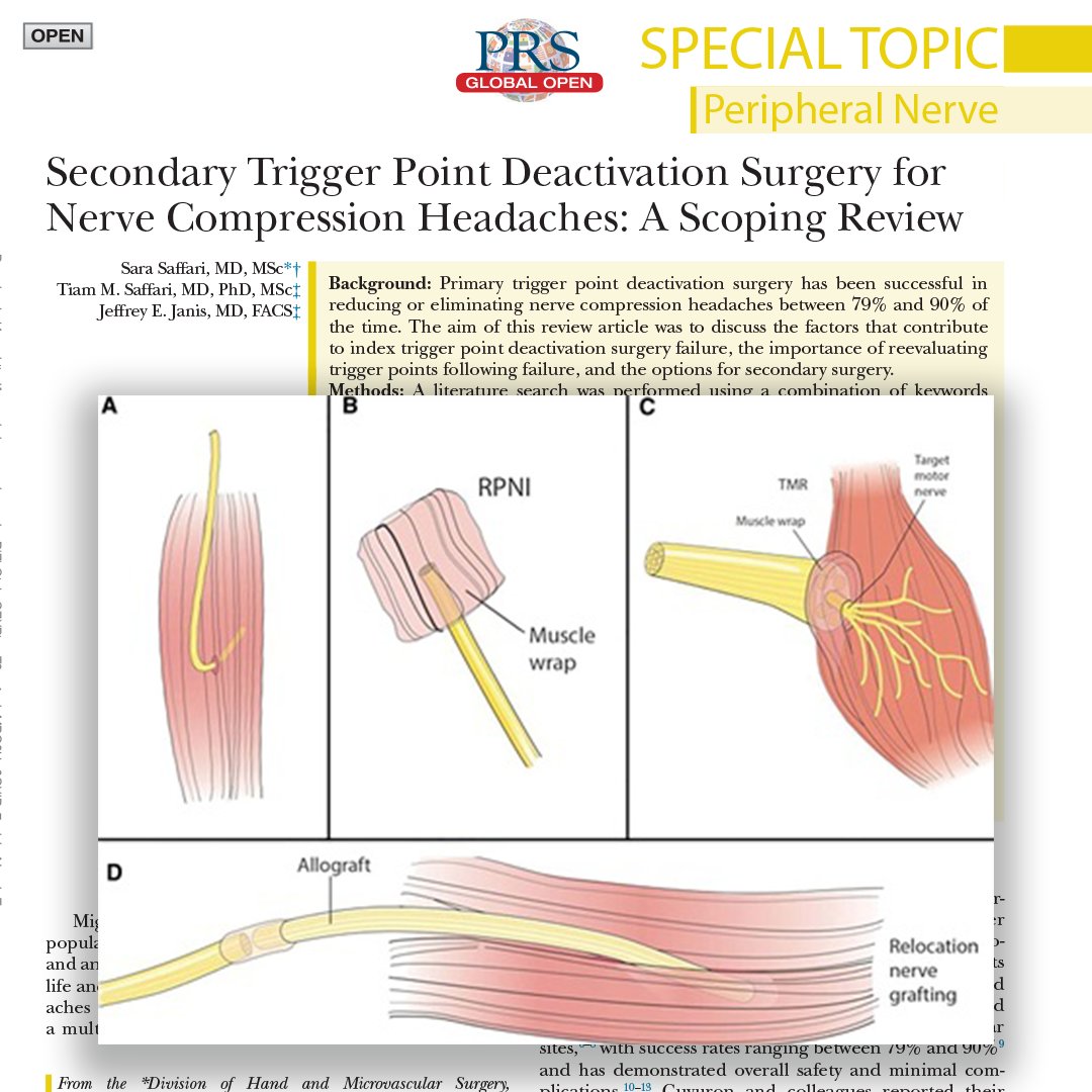 In this #PRSGlobalOpen study, the authors aimed to identify the factors contributing to index trigger point deactivation surgery failure, how to reevaluate these cases, and how to proceed with secondary surgery. Read their findings here: bit.ly/TriggerPointSu…