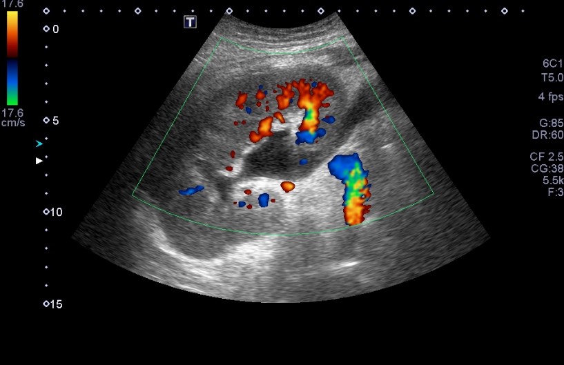 ...transplanted kidney with good perfusion...but with this finding...