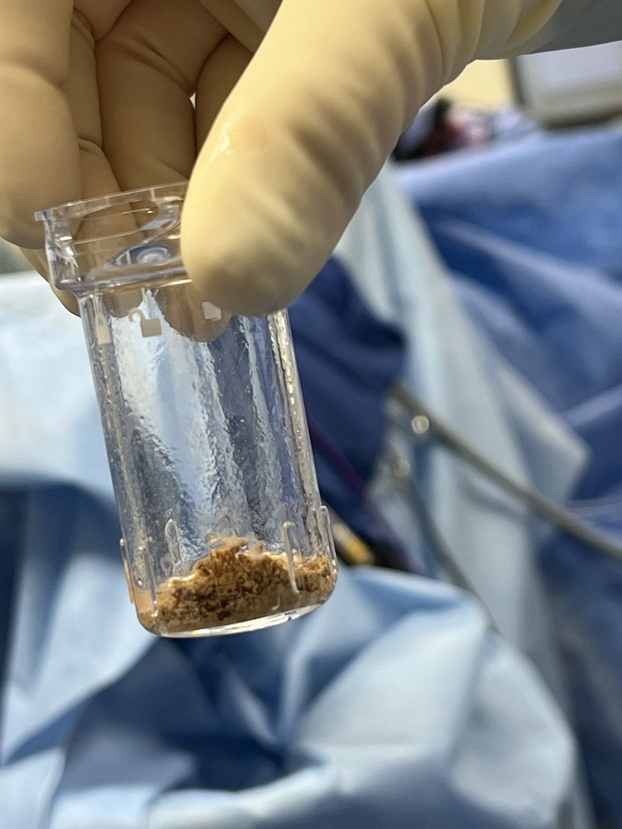 Jared Winoker MD (@jwinokermd) on Twitter photo 5 cases in and thoroughly impressed by the #CVACaspiration system. Iām generally hesitant to call anything a game-changer, but this partial staghorn didnāt stand a chance!
#nostoneleftbehind
<a href="/CalyxoInc/">Calyxo, Inc.</a> 5 cases in and thoroughly impressed by the #CVACaspiration system. Iām generally hesitant to call anything a game-changer, but this partial staghorn didnāt stand a chance!
#nostoneleftbehind
<a href="/CalyxoInc/">Calyxo, Inc.</a>