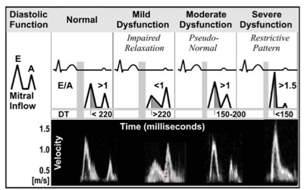 saikatmitra05's tweet photo. #Echocardiography #Weaning #MedTwitter

🔴 Echocardiography in ventilatory weaning:

1/ Diastolic filling patterns:-

🔹 Pseudonormal and restrictive patterns ➡️ higher rates of weaning failure 

🔗 https://t.co/ddfgQdmYVH

🔗 https://t.co/7cCgs59c5K https://t.co/bvxMoT4uNz