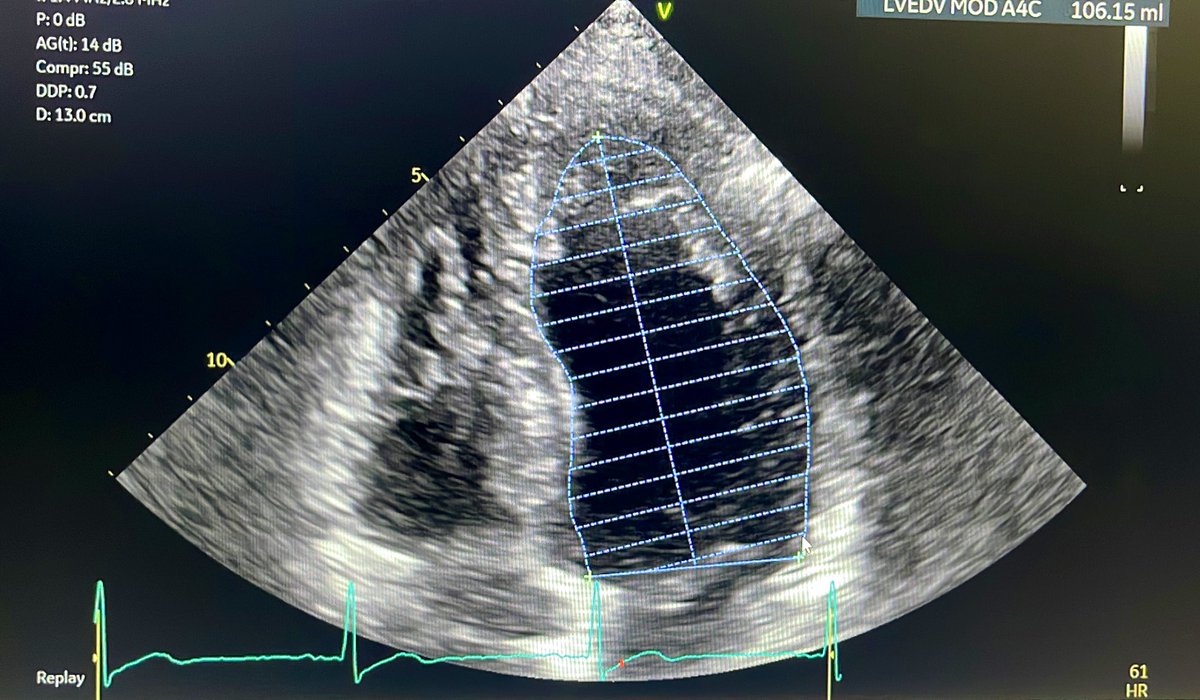 What is wrong with the BP tracing of EDV? @OHSUCardFellows @ASE360 @iamritu Foreshortening is not the correct answer .