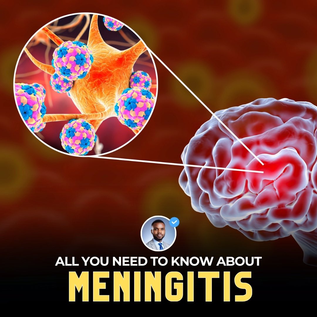 Nigeria becomes the first country in the world to roll out a 5 in 1 vaccine against meningitis The vaccine is called called Men5CV, recommended by the World Health Organization (WHO) This is a quick thread about meningitis and how you can stay safe 🔃tell someone by reposting