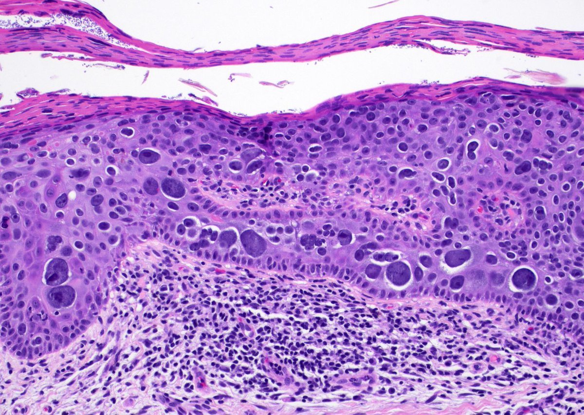 What #dermpath 'sign' is this? What are the cells with clear perinuclear halos?
More pics & Answers ✅ kikoxp.com/posts/17377 
Video ⏯️ kikoxp.com/posts/17324
More info: kikoxp.com/posts/7963
#pathology #pathologists #pathTwitter #dermatology #dermatologia #dermtwitter