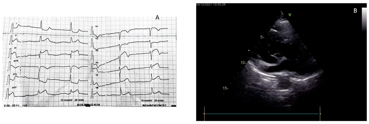 🔴🆕Enhancing STEMI Diagnosis and Management: The Integral Role of Echocardiography in Patients Rushed to the Cardiac Catheterization Laboratory #openAccess #2024Review mdpi.com/2077-0383/13/5… #CardioEd #Cardiology #FOAMed #MedEd #Cardiology #CardioTwitter