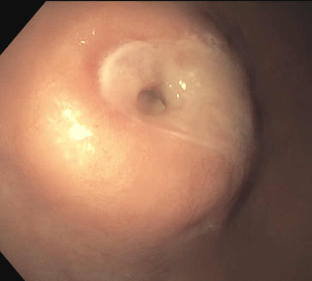 An extreme case of buried bumper syndrome associated with sepsis! Had to pass a guidewire and pull the PEG externally. Reused the tract for a low-profile gastrostomy feeding tube.