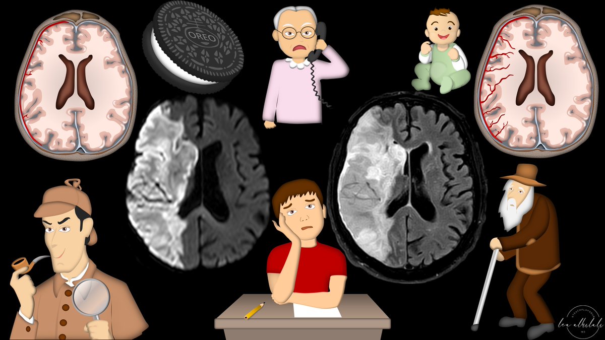 1/Time is brain! But what time is it? If you don’t know the time of stroke onset, are you able to deduce it from imaging? Here’s a thread to help you date a stroke on MRI!