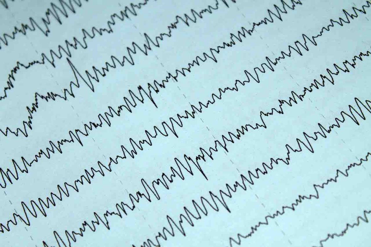 Are you considering staying at an Epilepsy Monitoring Unit (EMU) to have your #seizures recorded and open the doors for potential #epilepsy care options? Learn why an #EMU stay may be worth considering and Amber’s experience in them: ow.ly/Xvw150ReJcP #EEG #WADA #brainmap
