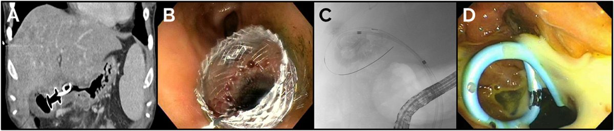 Practice Patterns of #Endoscopists Performing #EndoscopicGallbladderDrainage ow.ly/ubEn50RciO1 @VinayChandraMD @NickMcDonaldMD @BilalMohammadMD