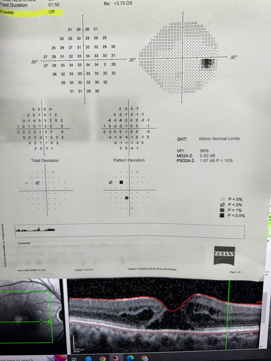 Here is a reminder to turn the foveal sensitivity “on” for your perimeter. Patient with a “normal” visual field test but with a macular hole with 20/150 visual acuity. Only the foveal sensitivity will flag this meaningful abnormality on standard automated perimetry.