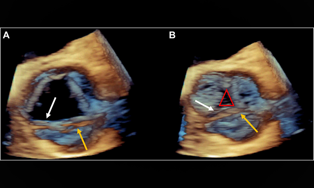 Aortic valve injury during invasive coronary angiography is rare. The reported incidence of this complication is 0.008% to 0.02% during diagnostic catheterization.

Here is a case of iatrogenic injury of the AV resulting in insidious aortic regurgitation. bit.ly/3vPs1mQ