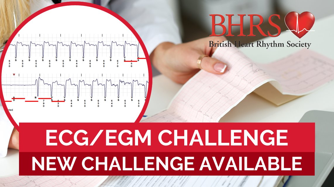 We are pleased to announce a new ECG/EGM Challenge for April: Recorded Pause On ICM.

This case was contributed by Matthew Carson, Chief Cardiac Physiologist, Aberdeen Royal Infirmary.

Take the Challenge: bhrs.com/ecg-egm-challe…

#ecgchallenge #egmchallenge