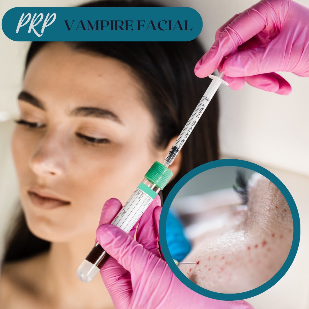 Beautywhitton's tweet photo. Experience the transformative power of our PRP Vampire Facial. Rejuvenate your skin with this cutting-edge procedure that utilizes your body's own growth factors for natural and radiant results.

#PRP #VampireFacial #Hairloss #Plateletrichplasma https://t.co/wVIqj537a6