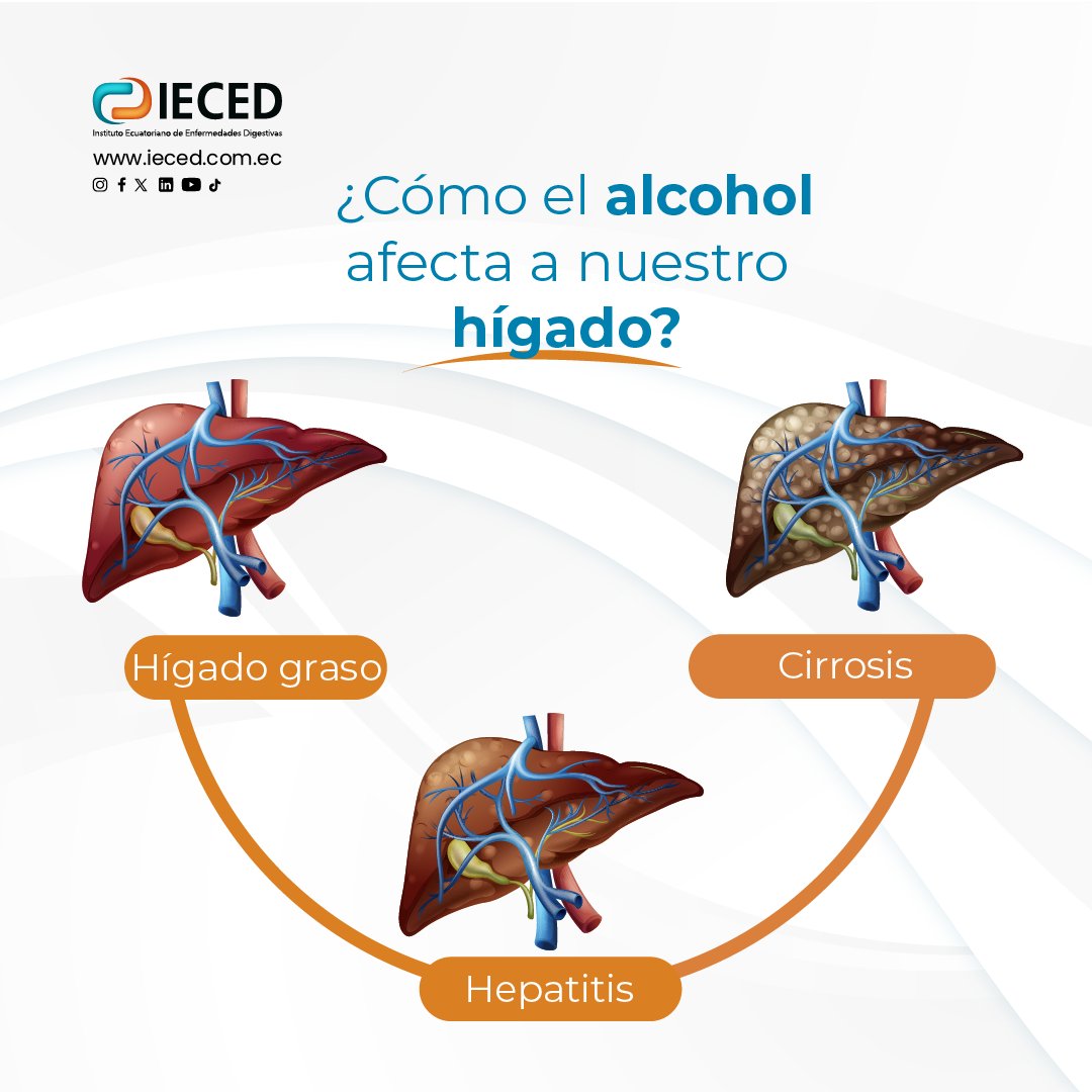 El consumo excesivo de alcohol afecta al hígado y puede provocar diversos problemas e inflamaciones hepáticas, que incluyen:
- Hígado graso.
- Hepatitis alcohólica
- Fibrosis

Cuida tu hígado con nuestros paquetes preventivos desde $40 

Escríbenos: 
bit.ly/3SS4T09