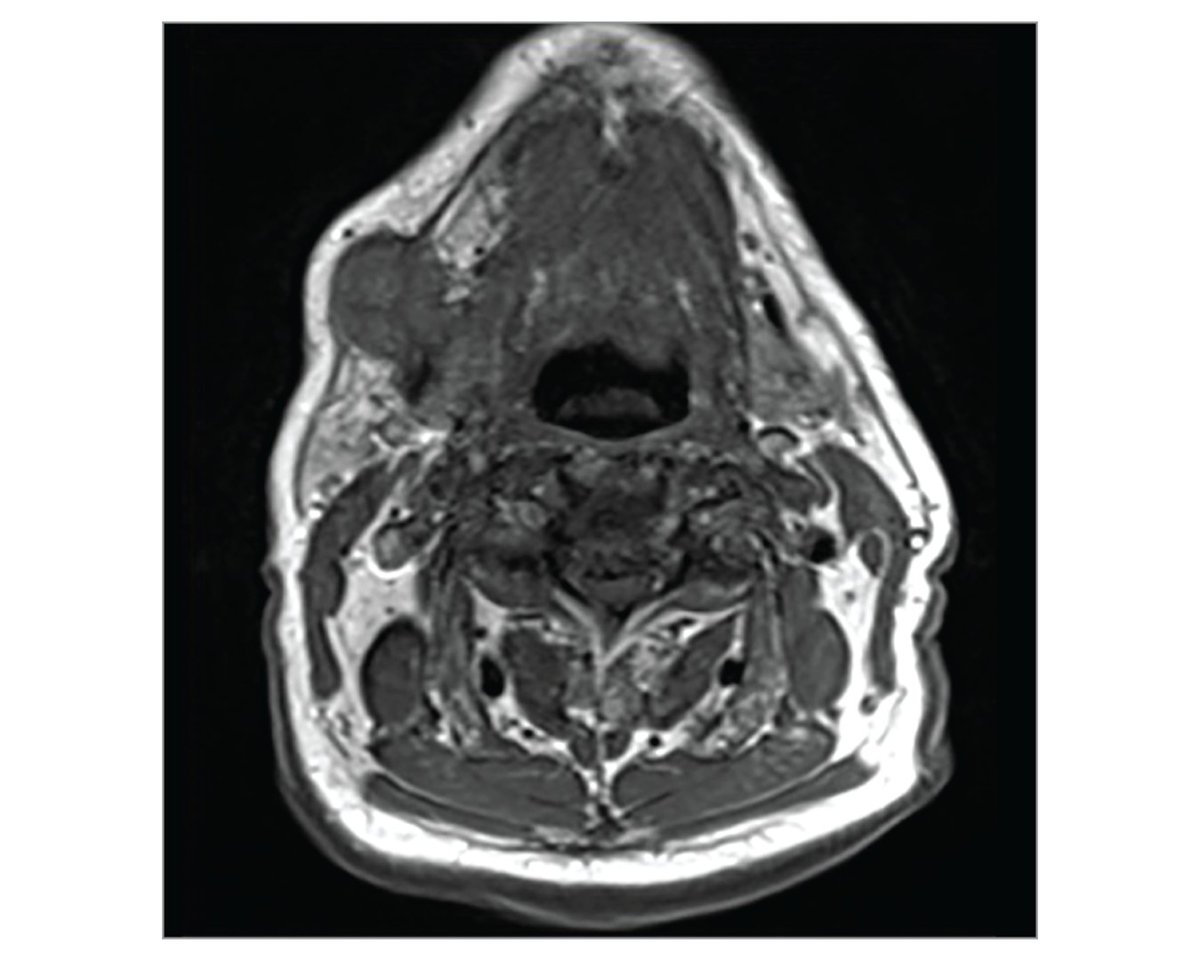 This case report describes an 89-year-old patient with prior cutaneous squamous cell carcinoma who presented with a new isolated metastasis and was subsequently treated with pembrolizumab, which produced a complete clinical response. ja.ma/3VWoXjE