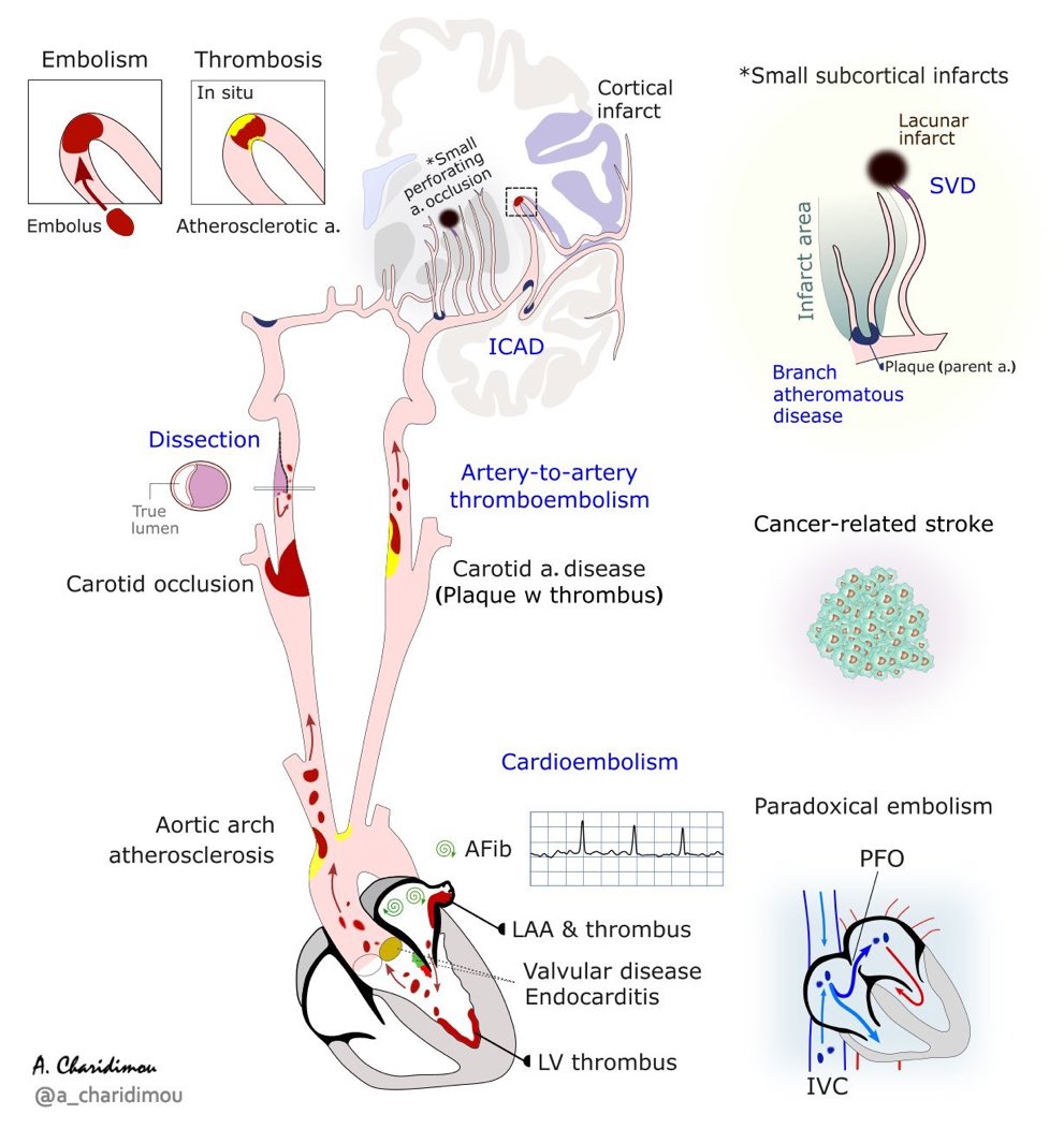 Causes of stroke by @a_charidimou