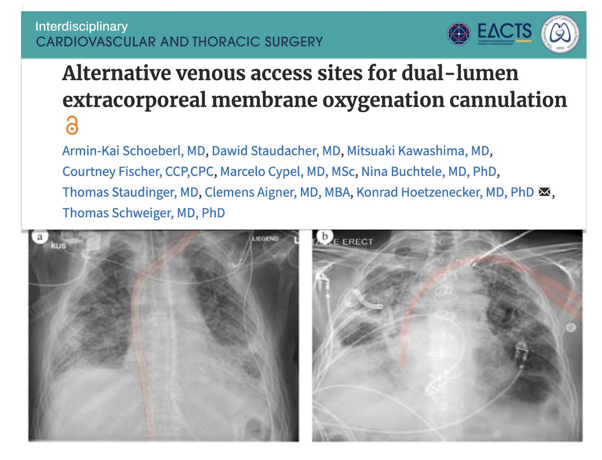 Looking for alternative venous access sites for dual-lumen #ECMO cannulae?? Take a look at this! Single site DLC VV #ECLS as BTT or BTR could be safe & feasible if inaccessible RIJV through LIJV, R/LSV, R/LFV. No procedural complications reported during cannulation. #FOAMcc…