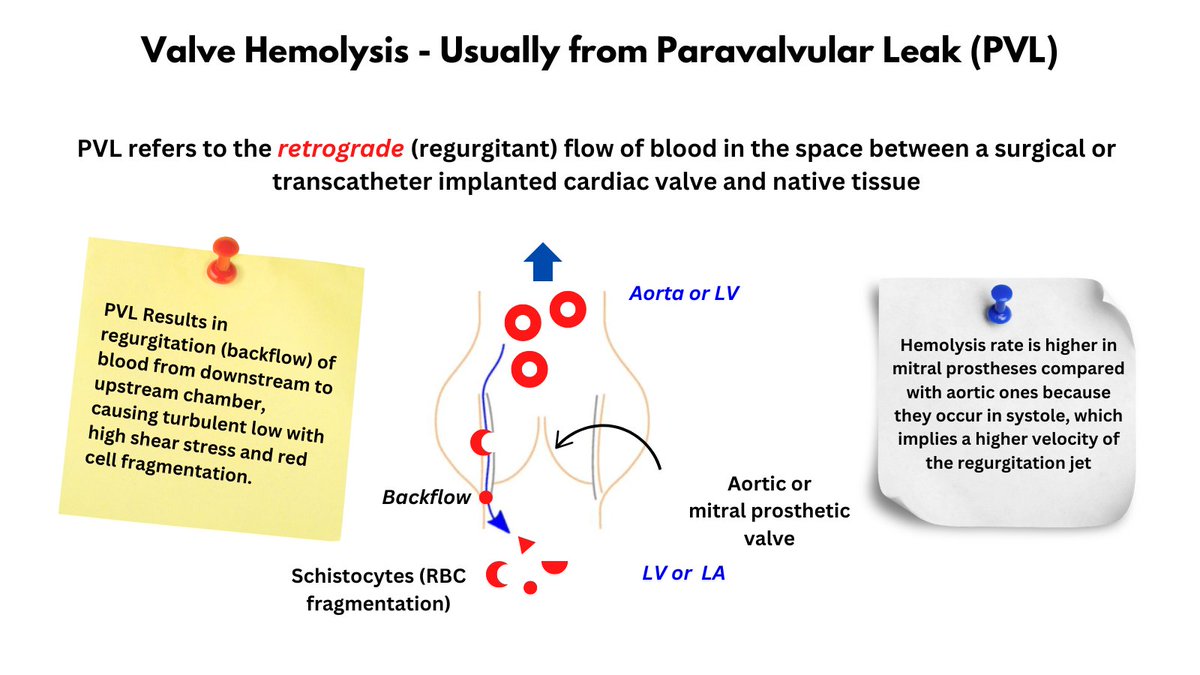 PARAVAVULAR LEAK AND HEMOLYSIS Simple image of how paravalvular leak from malfunctioning prosthetic valve leads to hemolysis with fragmentation. Also see explanation for why hemolysis more common with mitral compared with aortic vales. See also: thebloodproject.com/valve-hemolysi…
