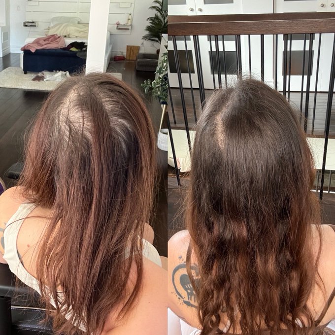 Not sexy like my normal content, but this is the 6 months progress of starting my hair loss treatments