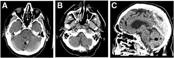 #STROKE Illustrative Teaching Case: Minimally invasive endoscopic evacuation of cerebellar intracerebral hemorrhage may minimize iatrogenic injury, with significant impact on patient recovery and functional recovery. #ICH ahajournals.org/doi/10.1161/ST… @NeurosurgUCSF @SavastanoLuisMD