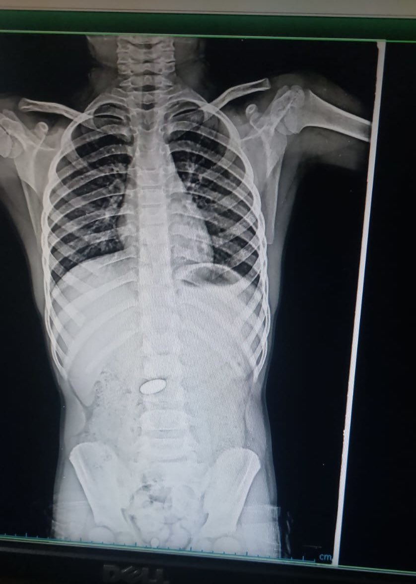 10 years old boy swallowed a coin.
Can you guess the location of coin ??
#MedEd #MedX #GITwitter