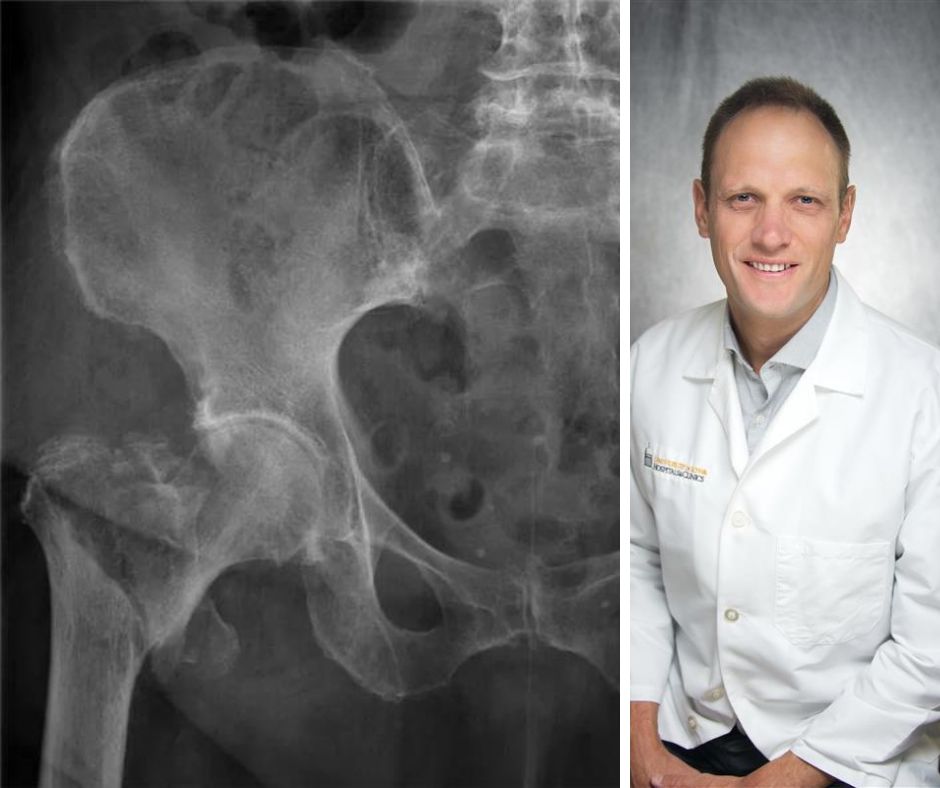 Amino acid supplementation shows promise in preserving function and independence for older patients with hip fractures, yet is understudied. Michael Willey, MD, along with other researchers have begun a clinical trial to discover its potential benefits. spr.ly/6011wQGyR