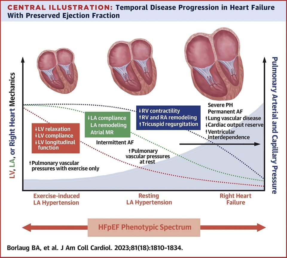 🔴 Heart Failure With Preserved Ejection Fraction: 2023 JACC Scientific Statement

sciencedirect.com/science/articl…
 #CardioEd #MedTwitter #MedX #MedEd #medtwitter #Cardiology #cardiotwitter #CardioTwitter #cardiotwiteros #cardiology