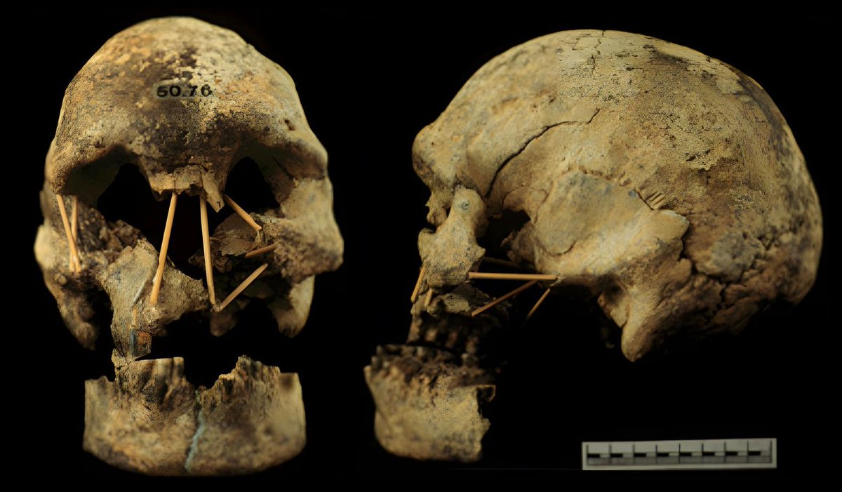 Coobool Creek 76 is longer than any Neanderthal skull and only 1 cm shorter than Dragon Man (the largest-known human skull). Like many archaic humans it has a true, unbroken supraorbital torus (brow ridge). #FossilFriday Found at Coobool Creek in southeast Australia, CC 76 was…