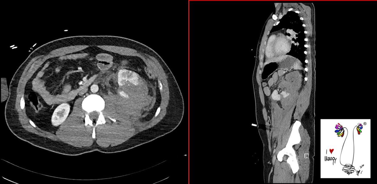 fabriziodalmoro's tweet photo. NEFRECTOMIA ROBOTICA D’URGENZA PER TRAUMA: È ormai raro, ma può capitare che, nonostante l’angiografia e l’embolizzazione, sia necessario eseguire una nefrectomia d’urgenza. Perché non farla per via robotica? 

We ❤️ Robotic Surgery!

EMERGENT ROBOTIC NEPHRECTOMY (TRAUMA): It’s rare nowadays, but it can happen that, despite angiography and embolization, emergency nephrectomy may be necessary. Why not perform it robotically?

#roboticsurgery #urology @UniPadova @Uroweb