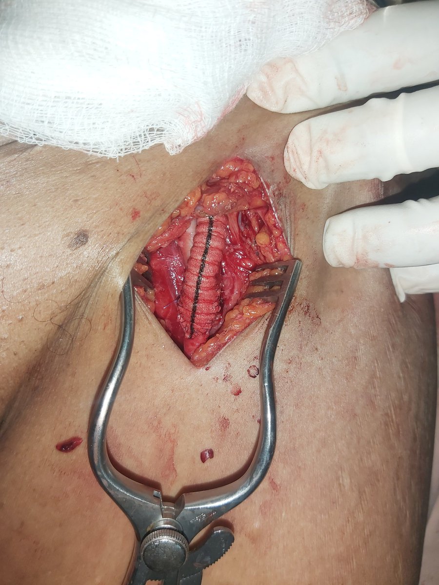 Dagim Leykun (@dagim_leykun) on Twitter photo 75F Aortoiliac occlusive disease treated with RCIA and LCFA aortic bypass. <a href="/HawassaUniverst/">Hawassa University</a> <a href="/gttefera/">Girma Tefera MD,FACS</a> <a href="/farkomd/">frank arko</a> #VascularSurgeryInEthiopia #AortaEd 75F Aortoiliac occlusive disease treated with RCIA and LCFA aortic bypass. <a href="/HawassaUniverst/">Hawassa University</a> <a href="/gttefera/">Girma Tefera MD,FACS</a> <a href="/farkomd/">frank arko</a> #VascularSurgeryInEthiopia #AortaEd