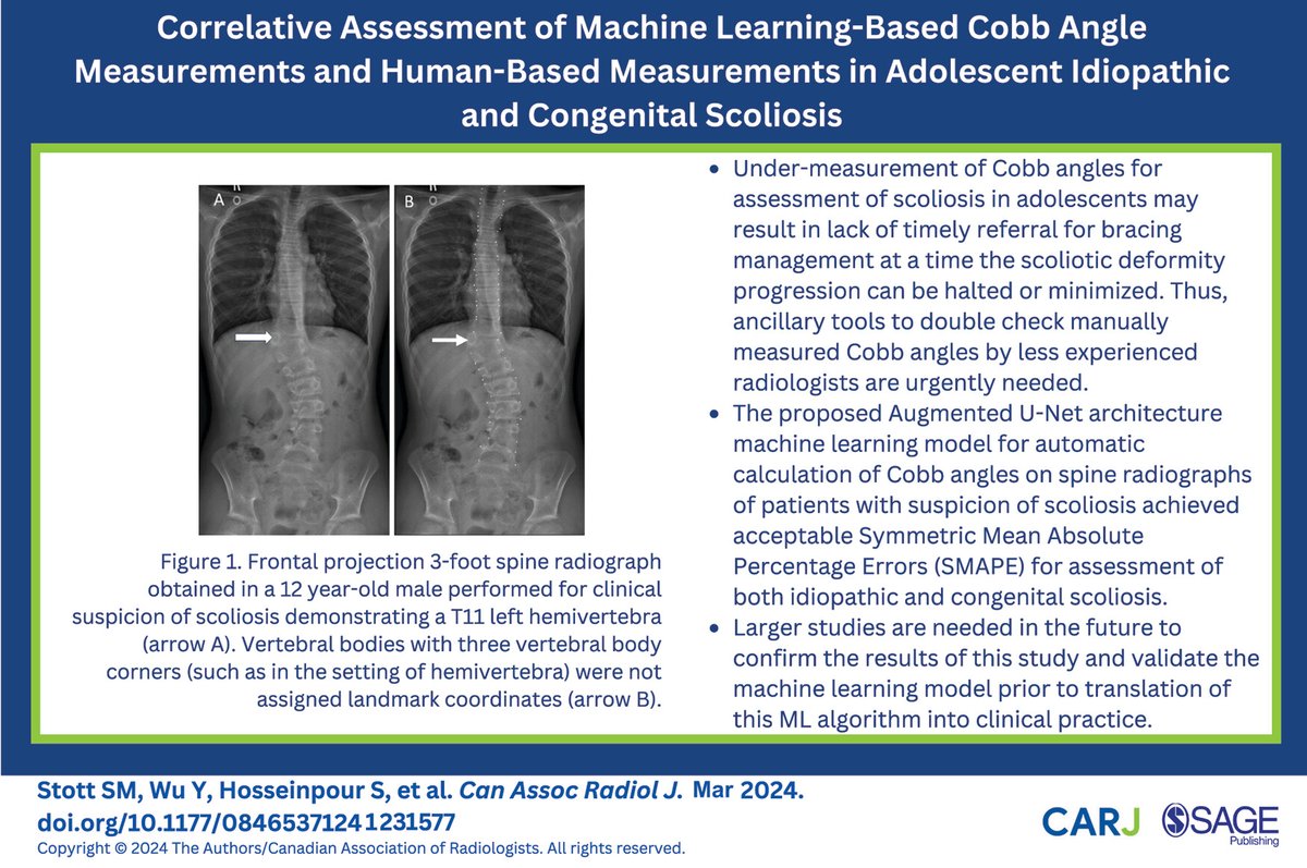 This recently published #openaccess study assesses the performance of machine-learning Cobb Angle measurements in adolescent idiopathic and congenital scoliosis: doi.org/10.1177/084653… @UofTMedIm @CARadiologists @SickKidsNews @SageJournals