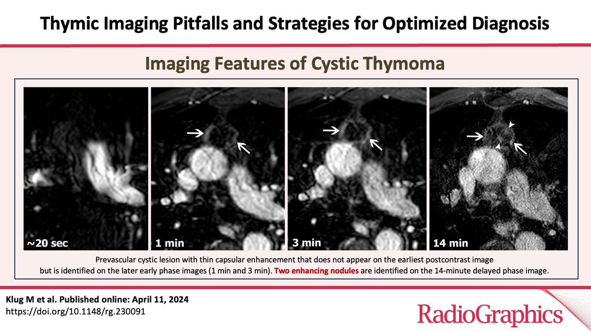 Happy to share my first full-lenght manuscript in @RadioGraphics 🔥🤩 Thanks to my mentor @MaromEdith for all her guidance and support. Thanks to the editor @cookyscan1 and all the great reviewers who made of this article a great educational resource 🙏🙏 pubs.rsna.org/doi/10.1148/rg…