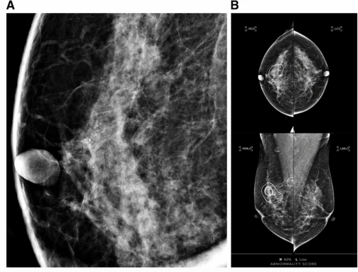 . #Mammography Based #AI Abnormality Scoring May Improve Prediction of Invasive Upgrade of DCIS diagnosticimaging.com/view/mammograp… @ACRRFS @ACRYPS @RadiologyACR @ARRS_Radiology @BreastImaging @SBIRFS @RadiologyUSC @RadiologyUcla @UofURadiology @UCSFimaging @UWRadiology #radiology #RadRes