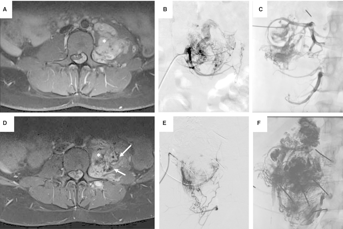 Schmidt et al. on extracranial #VascularAnomalies driven by #RAS/#MAPK variants: Spectrum and genotype-phenotype correlations. <a href="/VanessaFSchmidt/">Vanessa F. Schmidt, MD, MHBA, EDiR</a> #LMUradiology #APOLLON

doi.org/10.1161/JAHA.1…