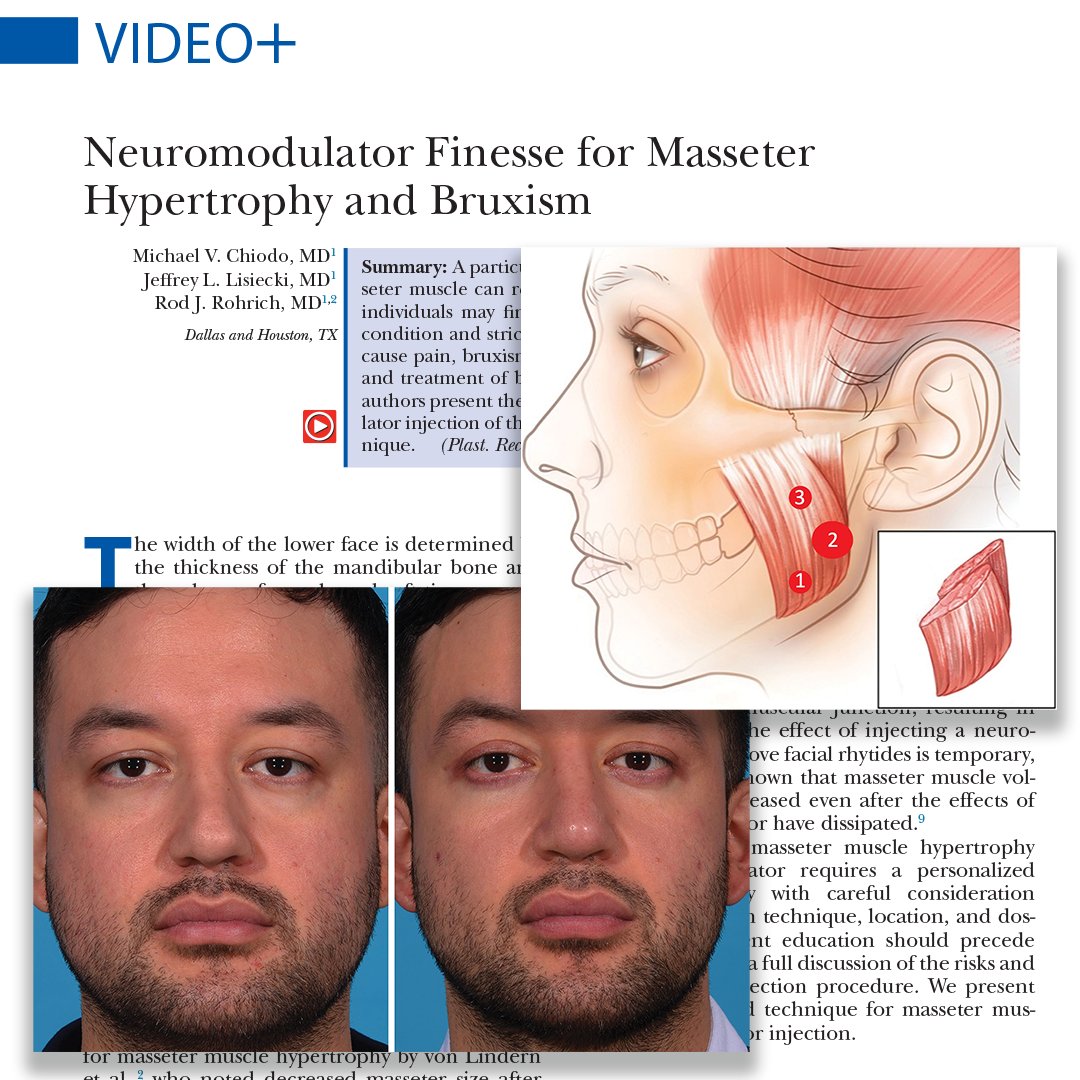 In this #PRSJournal article, the authors present the anatomic approach to neuromodulator injection of the masseter, with a corresponding video of the injection technique. Read the article today!: bit.ly/Neuromodulator…