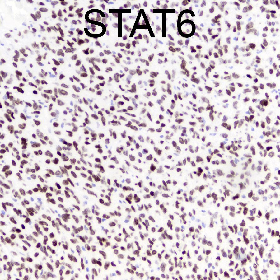 Dural-based mass in a middle-aged woman. Diagnosis? (You don't need to be locked up in SOLITARY confinement to get this one right.) #pathology #neuropath #PathTwitter