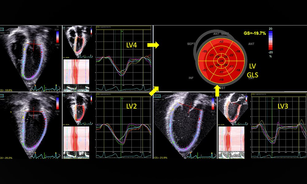 Echocardiography plays a crucial role in the evaluation of children with acquired and congenital heart disease (CHD). 🫀 Released earlier this year, read our #guideline, 'Guidelines for Performing a Comprehensive Pediatric Transthoracic Echocardiogram.' bit.ly/3OmOA8I